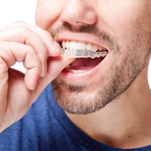 Precio ortodoncia invisalign ¿Cuánto cuesta? 【2024