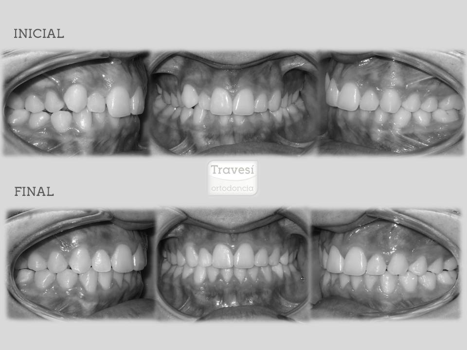 Qué es y Cómo funciona la ortodoncia invisalign?